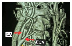 कैरोटिड आर्टरी गर्दन की उस धमनी को कहते हैं जो हृदय से मस्तिष्क में खून का प्रवाह करती है