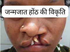जिला अस्पताल बीजापुर में सफल क्लेफ्ट लिप सर्जरी से 22 वर्षीय युवती के चेहरे पर लौटी मुस्कान