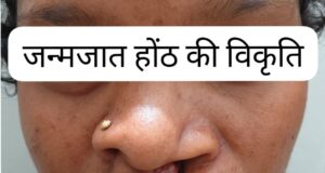 जिला अस्पताल बीजापुर में सफल क्लेफ्ट लिप सर्जरी से 22 वर्षीय युवती के चेहरे पर लौटी मुस्कान
