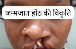 जिला अस्पताल बीजापुर में सफल क्लेफ्ट लिप सर्जरी से 22 वर्षीय युवती के चेहरे पर लौटी मुस्कान