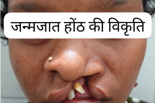 जिला अस्पताल बीजापुर में सफल क्लेफ्ट लिप सर्जरी से 22 वर्षीय युवती के चेहरे पर लौटी मुस्कान
